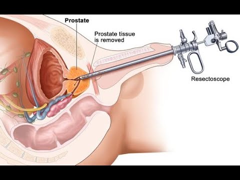 Transurethral resection of the prostate - TURP