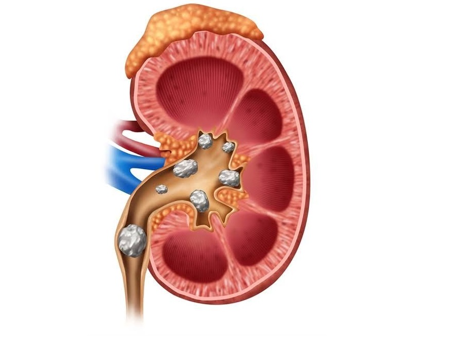 Reasons for kidney stone formation